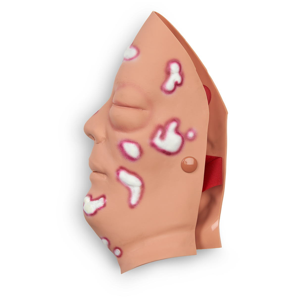 Wound – Mustard Gas, Face | Clever Scientific Laboratory